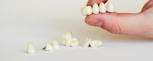 metalokeramičke krunice za zube