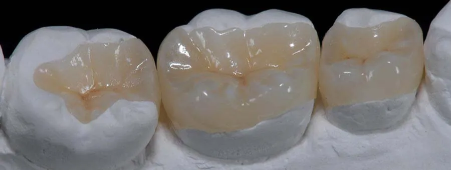 zubni inlej