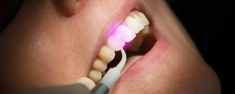 lasersko vadjenje zuba