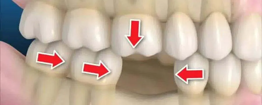 proces pomeranja zuba