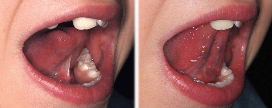 frenulum jezika