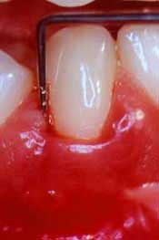 paradontoza zuba istaknuta instrumentom zubara. Krvarenje desni oko zuba.
